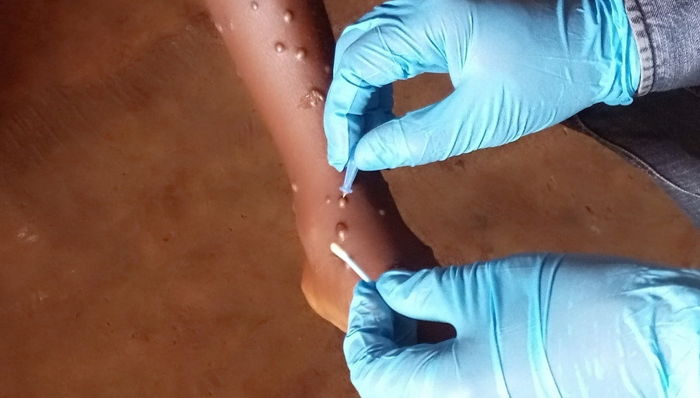 WHO and Ministry of Health officials take a sample from an mpox patient in Mongala , Democratic Republic of the Congo, on 26 March 2023. Credit: WHO / Katson Maliro
