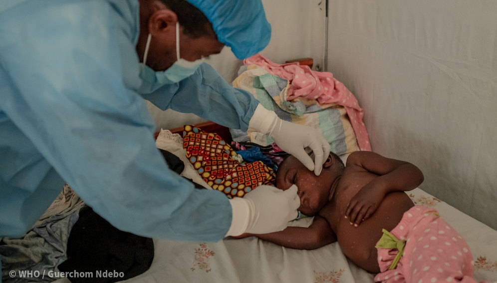 A health worker checks on a two-year-old child being treated for mpox, at Nyiragongo General Referral Hospital, north of Goma in the DRC in August 2024.