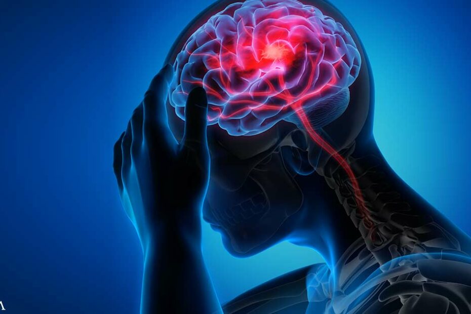 Does Excess Iron Raise Your Risk of Stroke Injury?