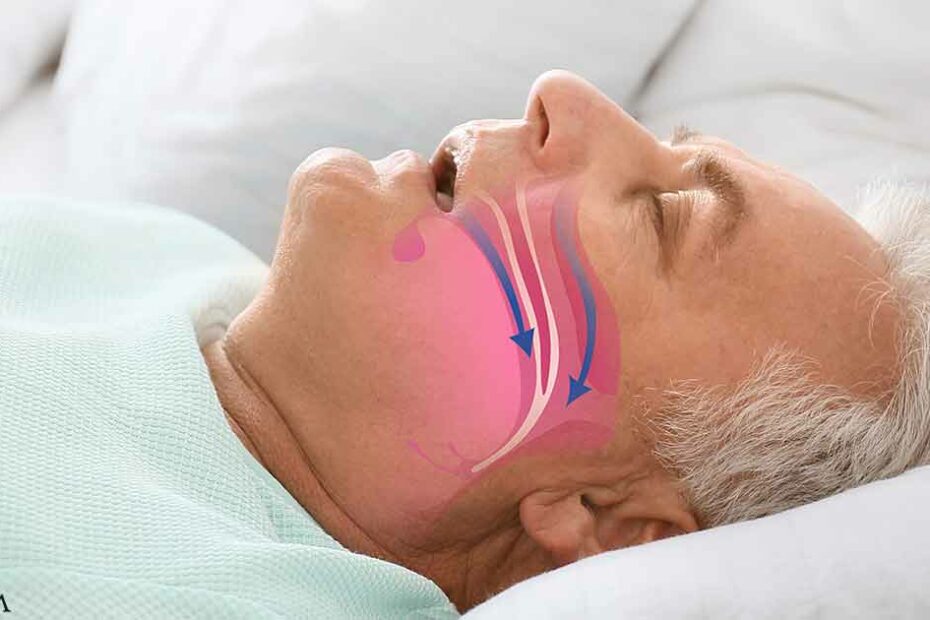 Getting Down to the Root of Obstructive Sleep Apnea