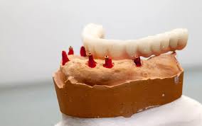 London's Guide to Life-Changing Tooth Replacement