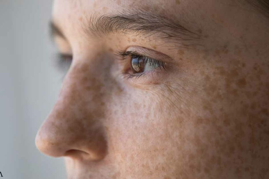 The Difference Between Freckles, Sunspots, and Moles