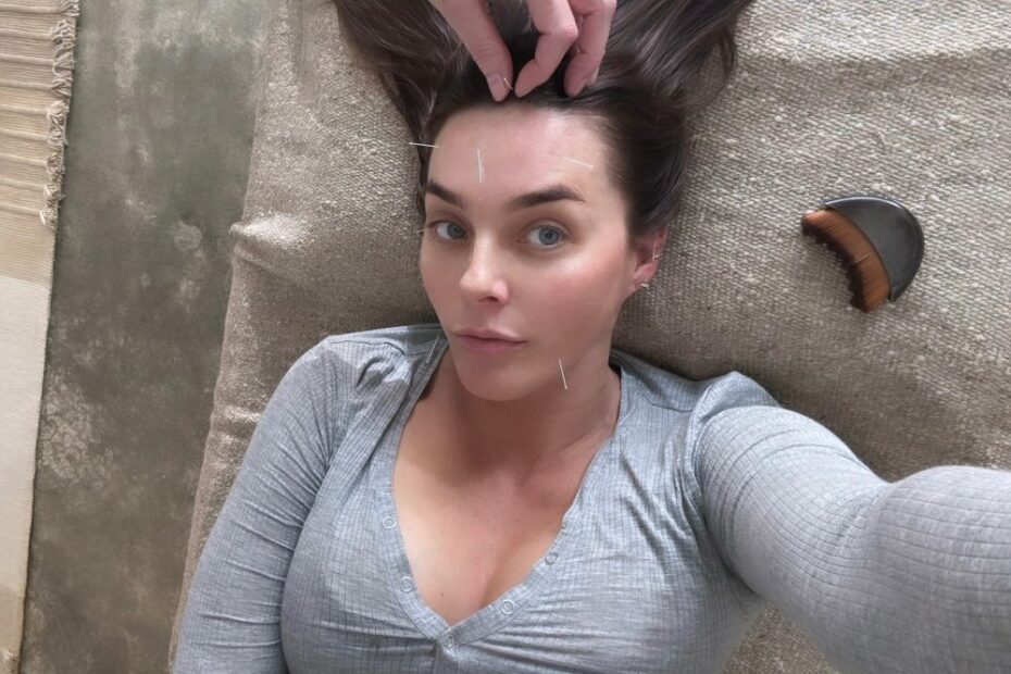 Cosmetic Acupuncture: Where Beauty Meets Balance | The Skinny Confidential