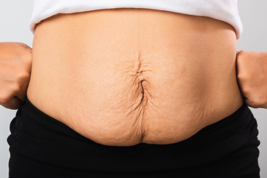 Managing Weight Loss Surgery Expectations: Real Talk