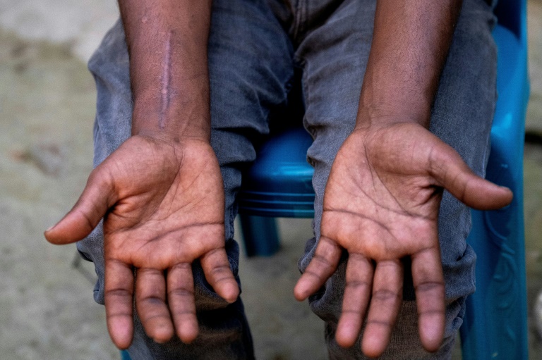 Shipbreaker Mizan Hossain, whose back was crushed in a 10-metre fall, showing his swollen hands
