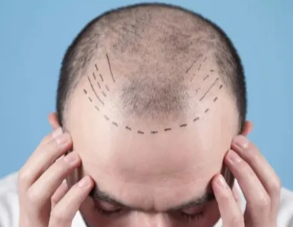 Hair System vs. Hair Transplant: Which One Is Right for You?