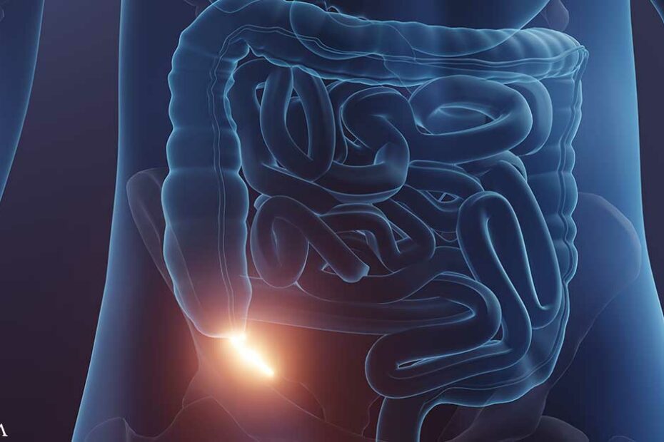 Appendix Cancer Is on the Rise Among Younger Generations