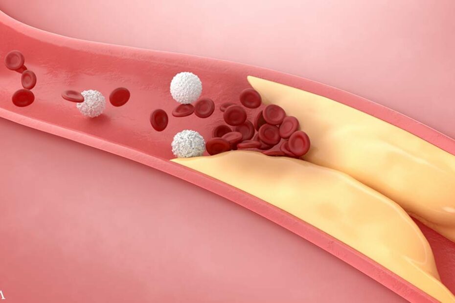 Low-Fiber Diets Linked to a Higher Risk for Heart Plaque