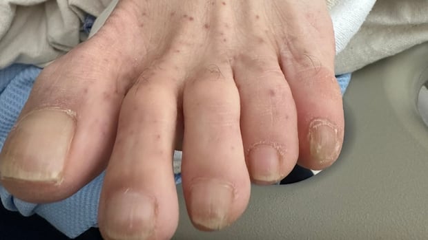 What to know about Rocky Mountain spotted fever, a tick-borne illness spreading in Canada | CBC News