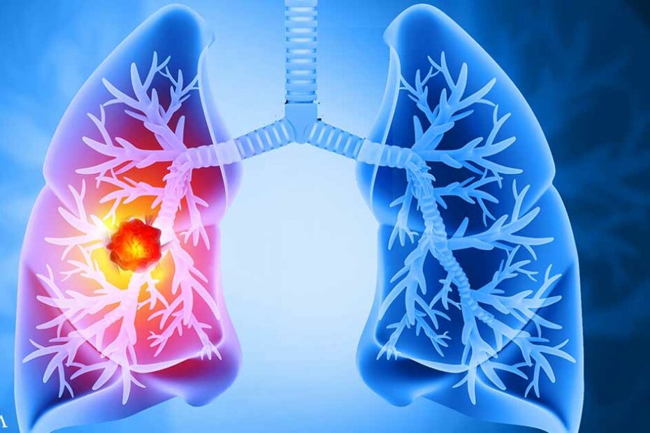 Could Processed Foods Be Fueling Your Lung Cancer Risk?