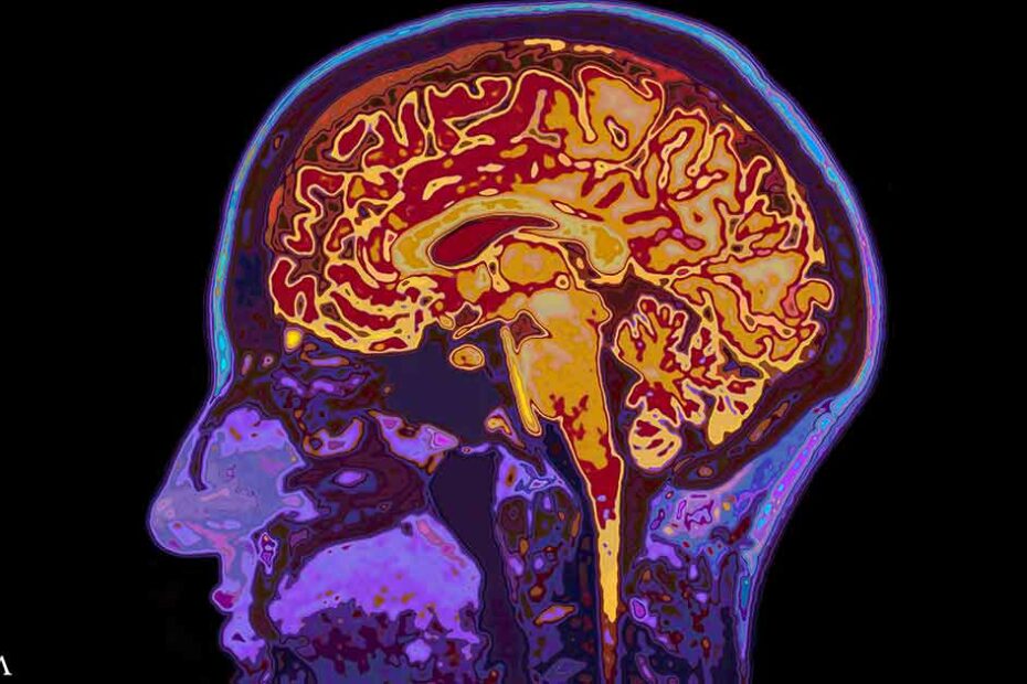 IBD Linked to Faster Dementia Decline