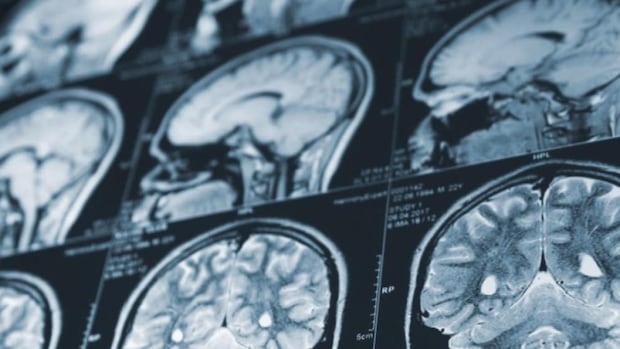 N.B. delays report on mystery brain illness, sends all data for federal review | CBC News
