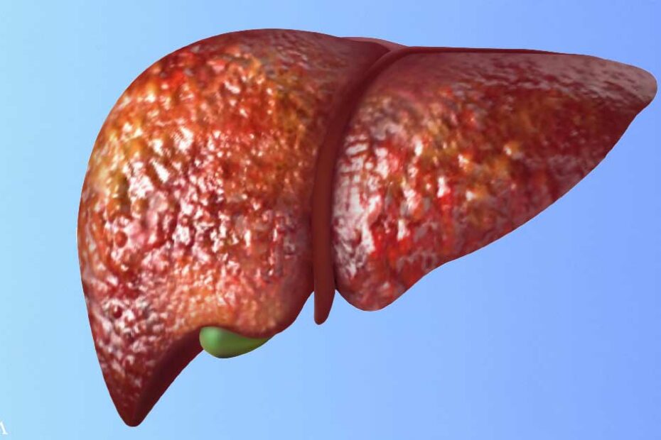 The Link Between Vitamin D Deficiency and Fatty Liver