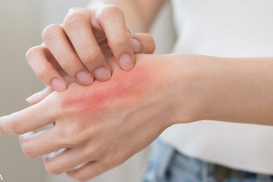 Understanding Hand Dermatitis and How to Heal It Naturally