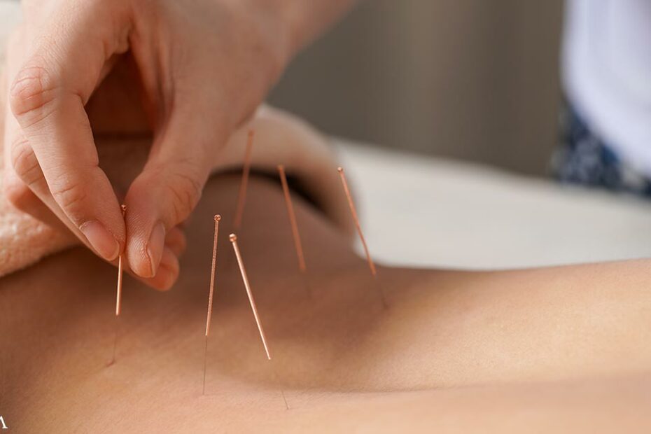 Exploring Acupuncture as a Time-Tested Option for Chronic Low Back Pain