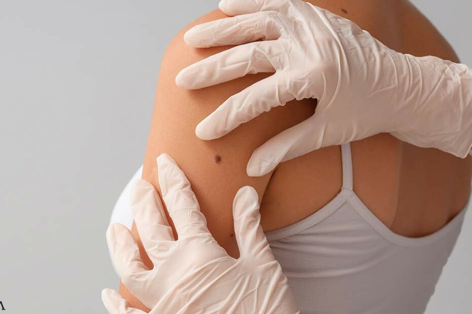 Niacinamide Found to Reduce the Risk of New Skin Cancers