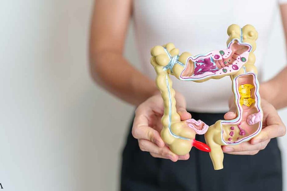 Severe Diverticulitis Is Rising Rapidly Among Younger Adults