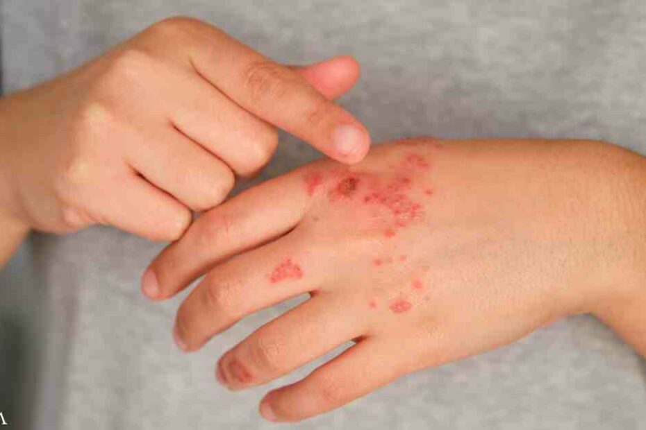 How Progesterone and DHEA Levels May Drive Psoriasis