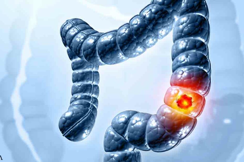 Ultraprocessed Foods Linked to Early Changes in Gut Health